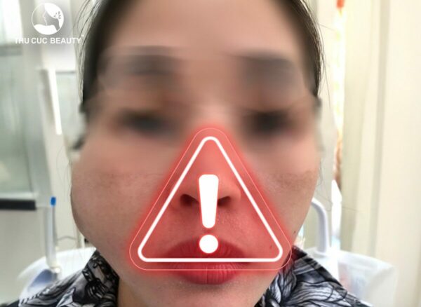 bien chung tiem filler 1 e1766118479330