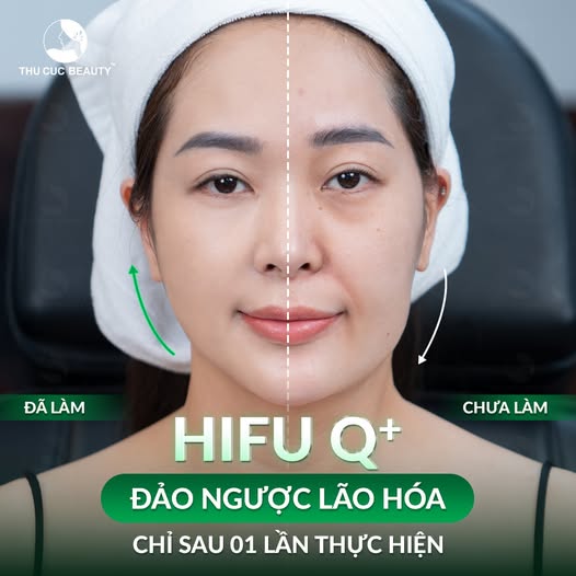 Rãnh cười sâu được cải thiện hiệu quả bằng công nghệ cao HIFU.