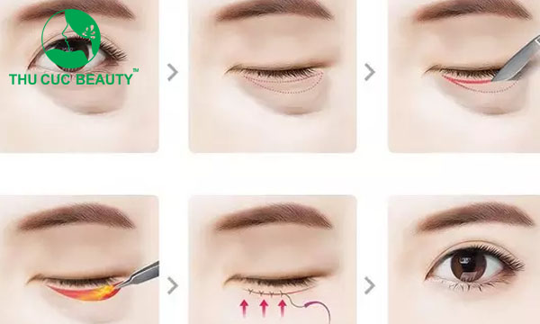 Quy trình cắt bọng mắt dưới