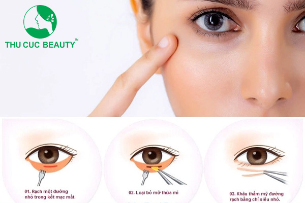 Cắt bọng mắt dưới bao nhiêu tiền?