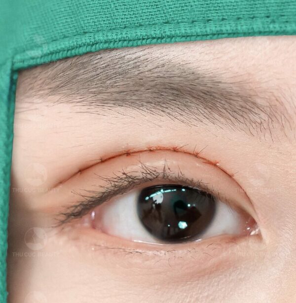 Cắt mí mắt đẹp an toàn tại Bệnh viện Thẩm mỹ Thu Cúc.