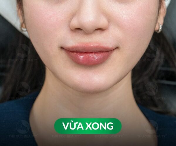 Hướng dẫn cách chăm sóc môi sau khi tiêm filler để nhanh đẹp 2 Chăm sóc môi sau khi tiêm filler.