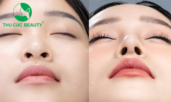 Chi phí thu gọn cánh mũi bao nhiêu tiền? 1 Chi phí thu gọn cánh mũi giá bao nhiêu?