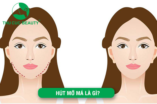 Có nên hút mỡ má không?