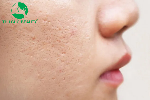 Những điều cần biết trước khi tiêm meso trẻ hóa.