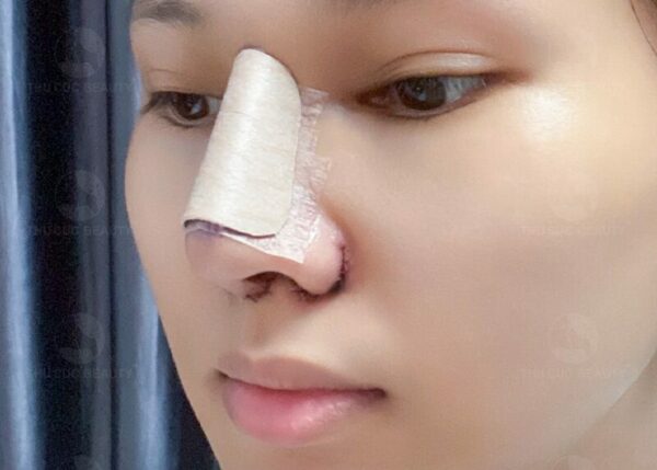 Cuộn cánh mũi và những điều cần biết.