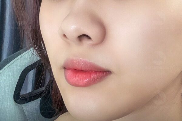 Cuộn cánh mũi và những điều cần biết.