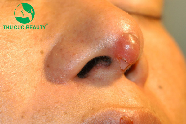 Chi phí rút chất liệu sụn mũi giá bao nhiêu?