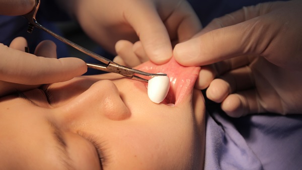 Độn cằm bằng chất liệu cho kết quả sắc nét và bền lâu hơn.