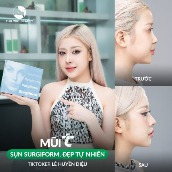 Nâng mũi sụn Surgiform đem lại vẻ đẹp tự nhiên. 