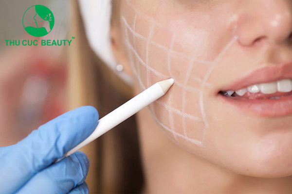 Có nên hút mỡ má không?