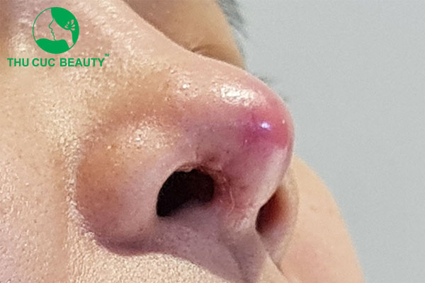 Nguyên nhân nâng mũi bị hở sụn.