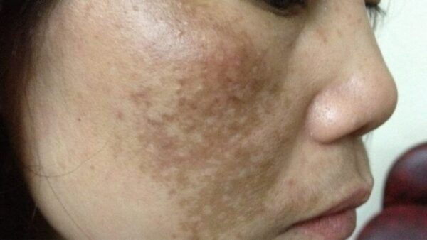 Nám da có chữa được không? Phương pháp nào hiệu quả? 1 Nám da hình thành do hắc tố melanin phát triển mạnh.