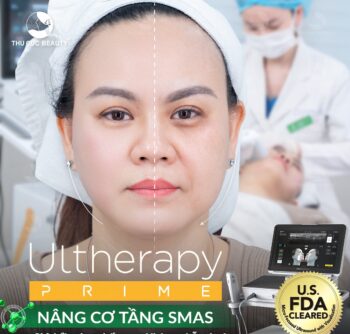 Nâng cơ mặt giá bao nhiêu? 