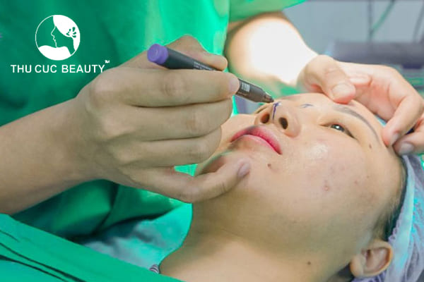 Nâng mũi bằng trung bì mỡ được bao lâu? 2 Nâng mũi bằng trung bì mỡ được bao lâu?