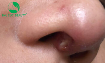 Nâng mũi bị hở sụn: Nguyên nhân và cách khắc phục