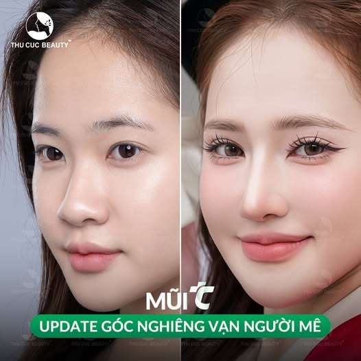 Giá nâng mũi bao nhiêu sẽ phụ thuộc vào phương pháp thực hiện.