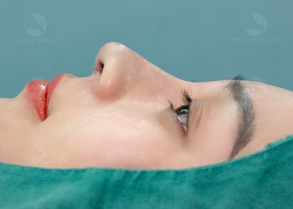 Hiện nay nâng mũi mổ phổ biến hơn, sẹo sẽ mờ đi theo thời gian.