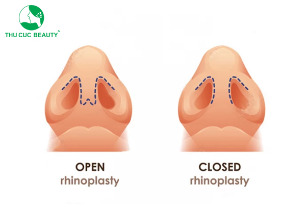 Nâng mũi mổ kín hay hở?