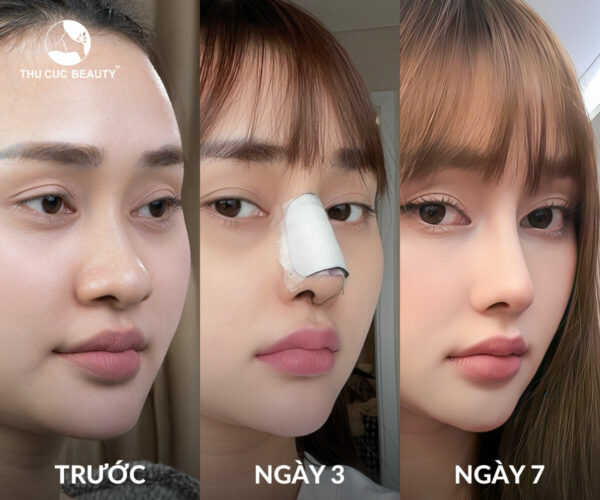 Sụn mũi Surgiform có tính tương thích cao, giúp hạn chế biến chứng.