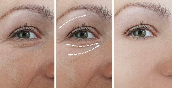 Phẫu thuật xóa rãnh lệ giúp đôi mắt trẻ trung hơn.