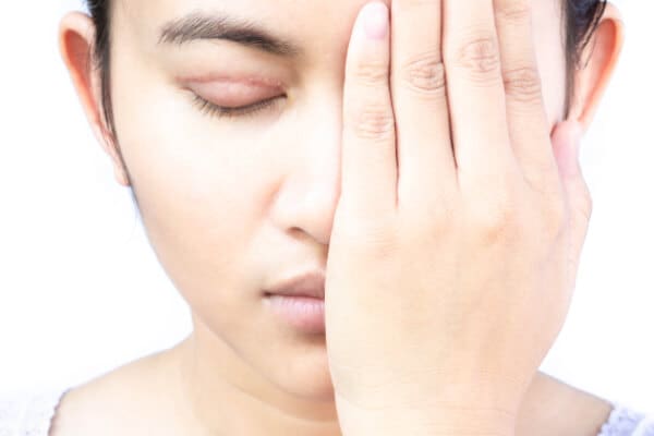 Tìm hiểu về các trường hợp cắt mí hỏng và cách khắc phục