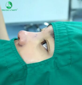 Cuộn cánh mũi là gì? Cuộn cánh mũi giá bao nhiêu?