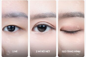 Cắt mí có để lại sẹo không?