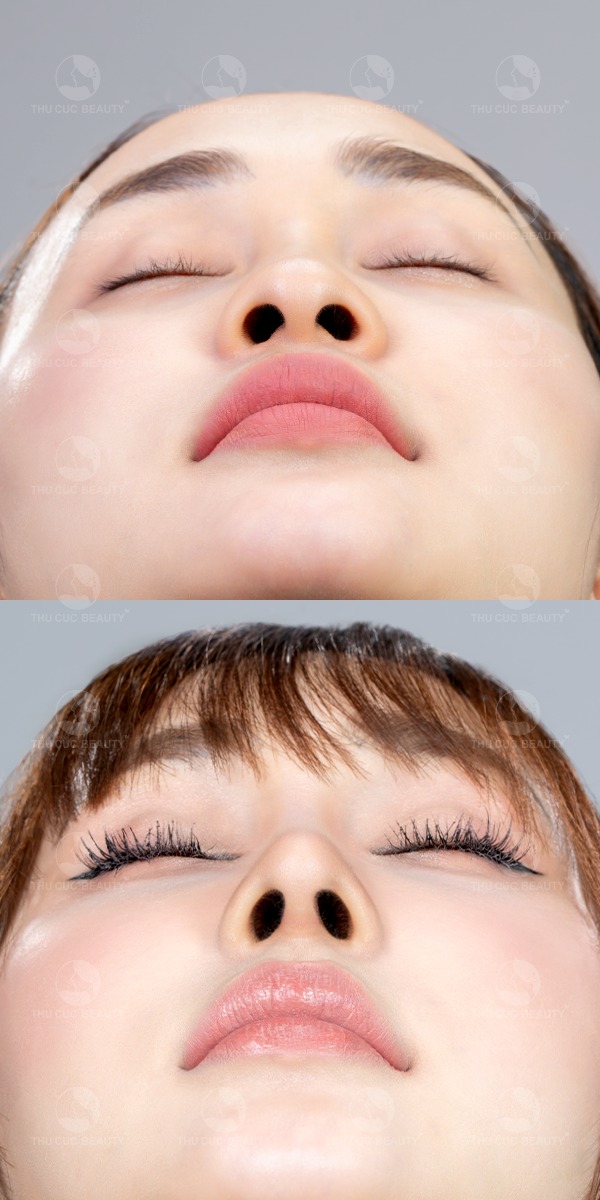 Nâng mũi sụn Surgiform cho dáng mũi tự nhiên.