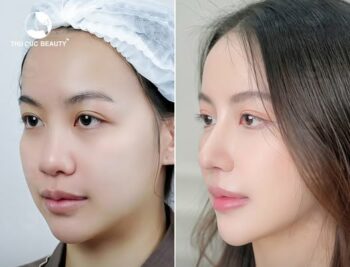 Giá nâng mũi bao nhiêu tiền? 