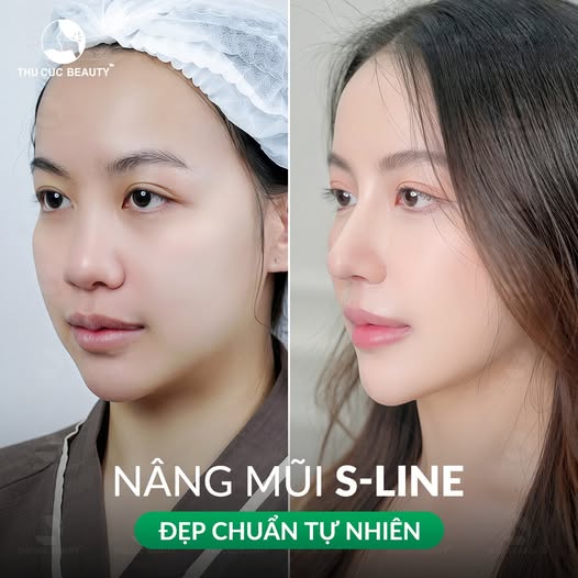 Giá nâng mũi bao nhiêu tiền? 3 Giá nâng mũi bao nhiêu sẽ phụ thuộc vào phương pháp thực hiện.