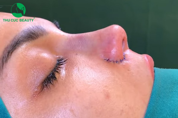 Chi phí thu gọn cánh mũi bao nhiêu tiền?