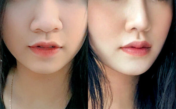 Thu hẹp nền mũi bao nhiêu tiền? 1 Thu hẹp nền mũi bao nhiêu tiền?