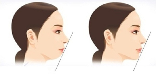 Nên tiêm filler cằm hay cấy mỡ tự thân?