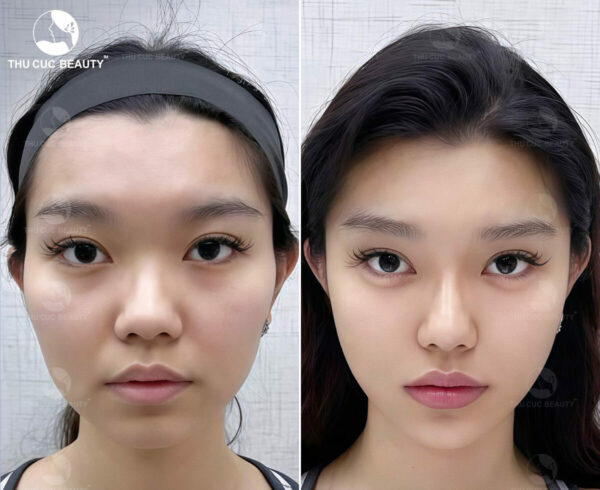 Cẩn trọng khi tiêm filler nhiều 2 5 hiểu lầm thường gặp khi tiêm filler.