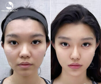 Tiêm filler thái dương có an toàn không?