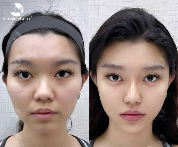 Tiêm filler thái dương an toàn tại Bệnh viện Thẩm mỹ Thu Cúc.