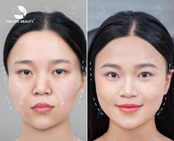 Tiêm filler kiêng gì để nhanh đẹp và vào form?