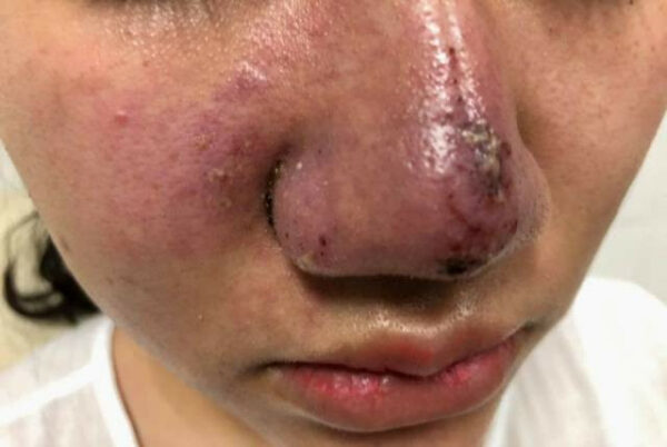 Tiêm filler mũi tự tan được không?