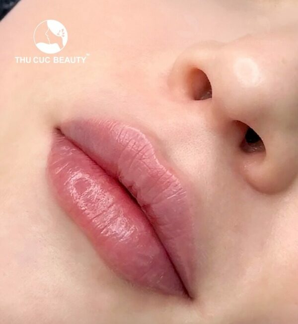 Tiêm filler môi giữ được bao lâu?