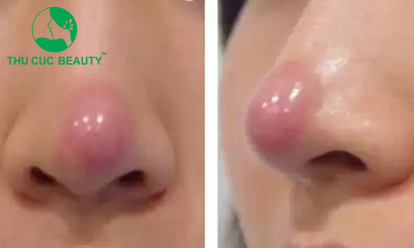 Nâng mũi không bọc đầu mũi có sao không?