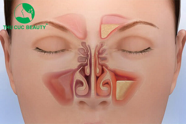 Viêm xoang có được nâng mũi không? 1 Viêm xoang có được nâng mũi không?