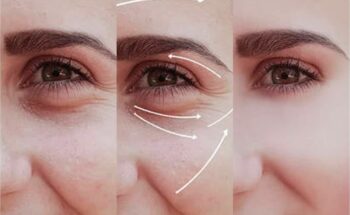 Xóa rãnh lệ bao nhiêu tiền? Xóa rãnh lệ có đắt không?