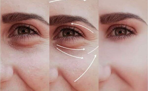 Phẫu thuật xóa rãnh lệ bao nhiêu tiền?