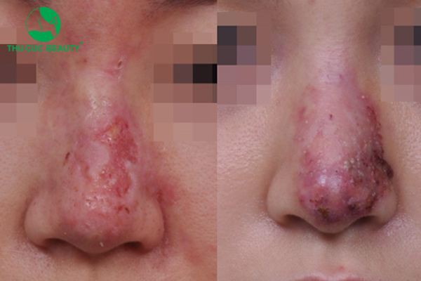 Cảnh báo nâng mũi S-line giá rẻ gây biến chứng.