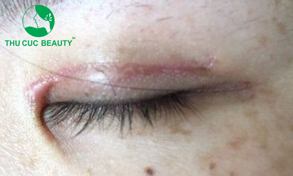 Cắt mí mắt lần 2 nhằm khắc phục khuyết điểm từ lần thực hiện đầu tiên.