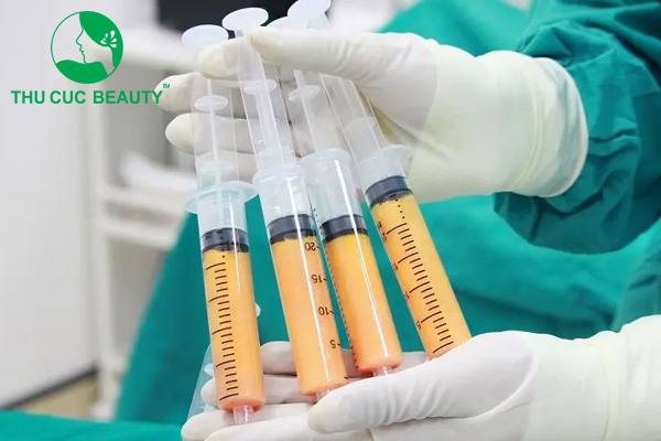 Cấy mỡ tự thân giúp lấp đầy vùng lõm một cách tự nhiên.