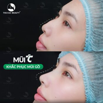 Chỉnh xương mũi gồ bao nhiêu tiền?