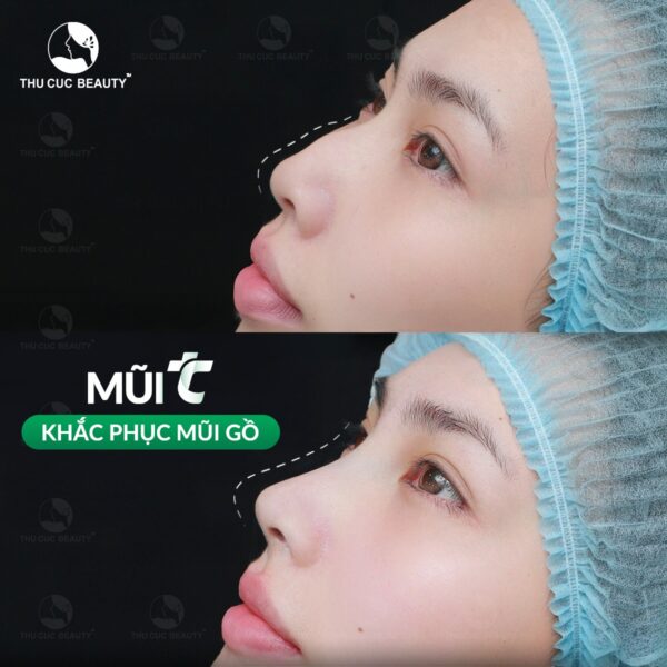 Chỉnh xương mũi gồ giúp mũi thẳng thanh thoát hơn.