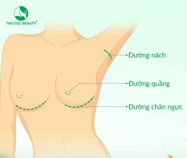 Những điều mà người có cơ địa sẹo lồi cần lưu ý khi nâng ngực. 